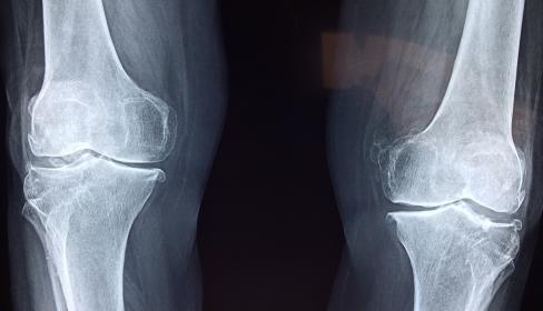 xray-of-knees-how-vitamin-D-affects-mental-health-iMind-Mental-Health-Solutions